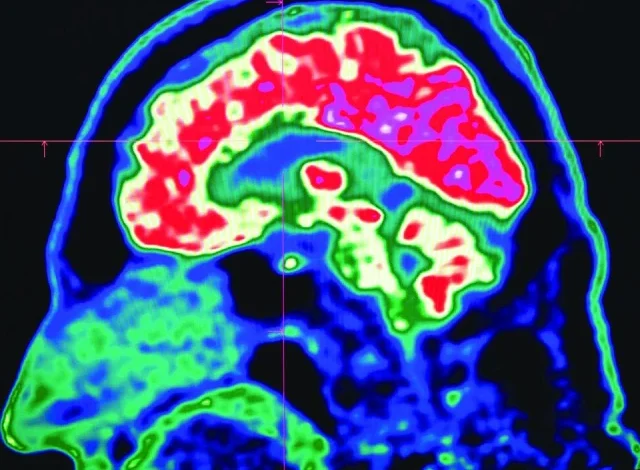 Do microplastics mess up our minds?